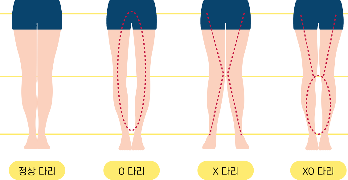 내반슬(O형) / 외반슬(X형) 휜 다리